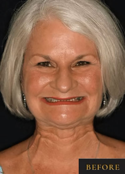 Smile Makeover - Before