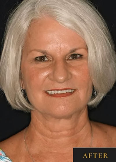 Smile Makeover - After