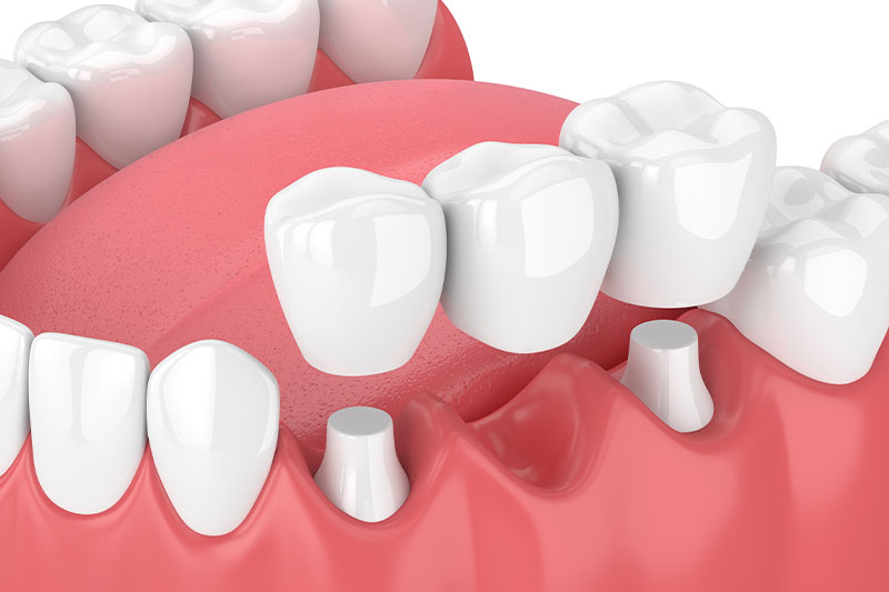 Dental Bridges in Clarksburg