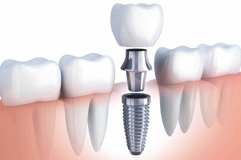 Implants Dentist in Clarksburg
