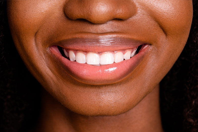 Smile Makeover in Clarksburg