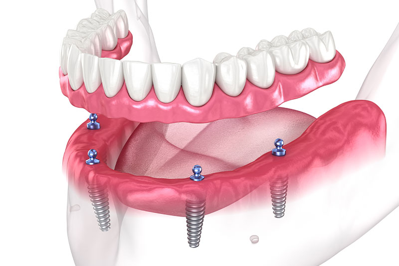 Implant-Supported Dentures in Clarksburg