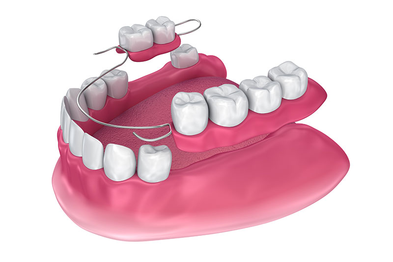 Partial Dentures in Clarksburg